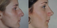 Rhinoplasty. Before and After Treatment Photos - female, right side view, patient 9