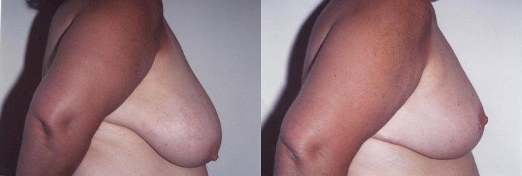 Breast Reduction Gallery