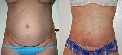 Mini Tummy Tuck Gallery