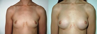 Breast Augmentation Gallery