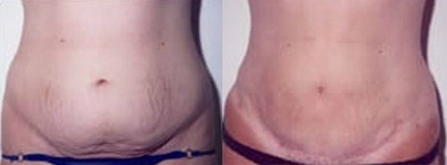 Tummy Tuck Gallery