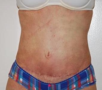 Mini Tummy Tuck - After Treatment Photos - female, front view, patient 1