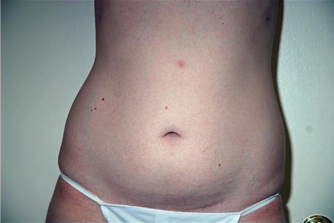 Liposuction Abdomen - Before Treatment Photos - male, front view, patient 7