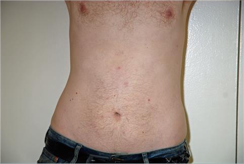 Liposuction Abdomen - After Treatment Photos - male, front view, patient 7