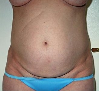Mini Tummy Tuck - Before Treatment Photos - female, front view, patient 1