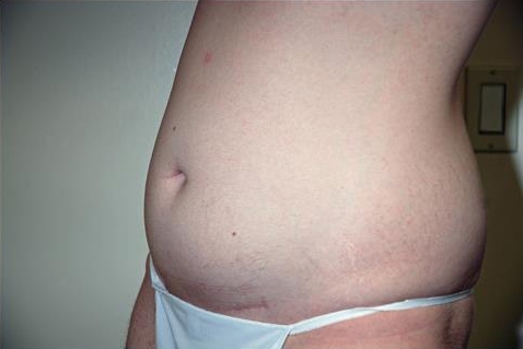 Liposuction Abdomen - Before Treatment Photos - male, oblique view, patient 8