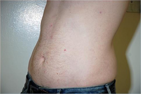Liposuction Abdomen - After Treatment Photos - male, oblique view, patient 8