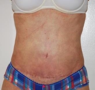 Tummy Tuck - After Treatment Photos - female, front view, patient 4