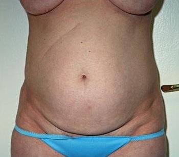 Tummy Tuck - Before Treatment Photos - female, front view, patient 4