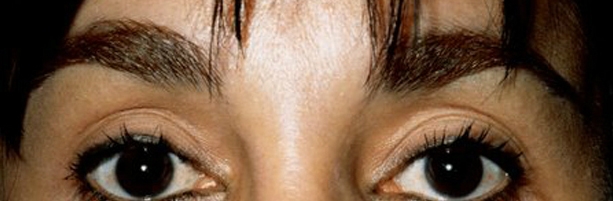 Browlift: After Treatment Photos - female, front view, patient 2
