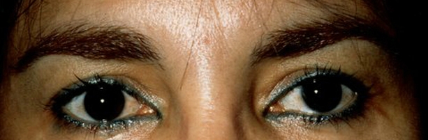 Browlift: Before Treatment Photos - female, front view, patient 2