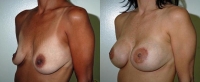 Breast Augmentation: Before and After Treatment Photos - female, left side oblique view, patient 18