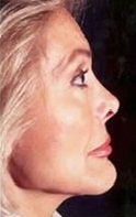 Facelift - After Treatment Photos - female, right side view, patient 1