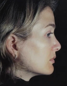 Rhinoplasty. After Treatment Photos - female, right side view, patient 11