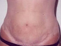 Tummy Tuck - After Treatment Photos - female, front view, patient 1