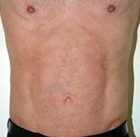Torsoplasty. After Treatment Photos - male, front view, patient 1