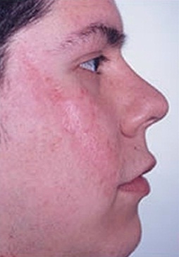 Skin Treatments - After Treatment Photos - female, right side view, patient 1 (face)