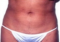 Liposuction Abdomen - After Treatment Photos - female, front view, patient 1