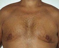 Gynecomastia. After Treatment Photos - male, front view, patient 1