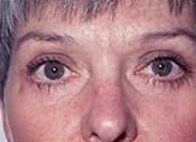 Mid Facelift - After Treatment Photos - female, front view, patient 1