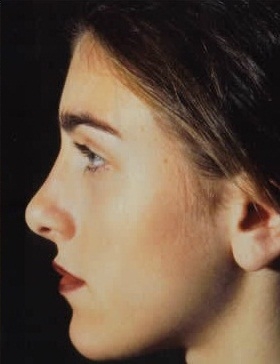 Rhinoplasty. After Treatment Photos - female, left side view, patient 12