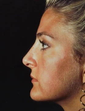 Rhinoplasty. After Treatment Photos - female, left side view, patient 13