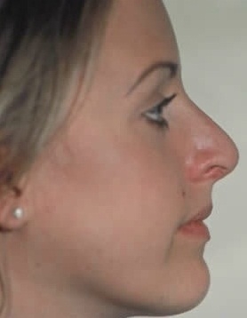 Rhinoplasty. After Treatment Photos - female, right side view, patient 14
