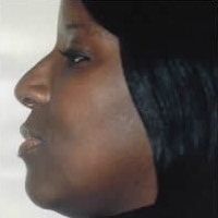 Rhinoplasty. After Treatment Photos - female, left side view, patient 15