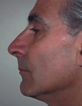 Rhinoplasty. After Treatment Photos - male, left side view, patient 17