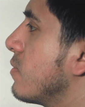 Rhinoplasty. After Treatment Photos - male, left side view, patient 18