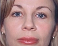 Mid Facelift - After Treatment Photos - female, front view, patient 2