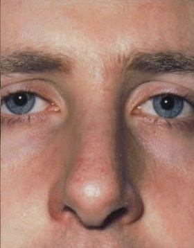 Rhinoplasty. After Treatment Photos - male, front view, patient 21
