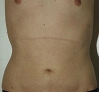 Torsoplasty. After Treatment Photos - male, front view, patient 2