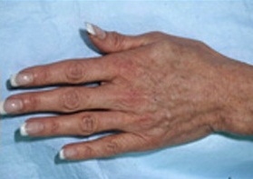 Skin Treatments - After Treatment Photos - female, top view, patient 2 (hands)