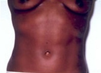 Liposuction Abdomen - After Treatment Photos - female, front view, patient 2