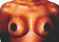 Breast Augmentation: After Treatment Photos - female, front view, patient 2