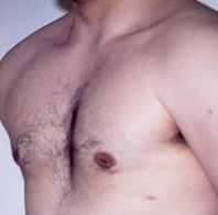 Gynecomastia. After Treatment Photos - male, oblique view, patient 2