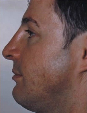 Rhinoplasty. After Treatment Photos - male, left side view, patient 22