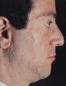 Rhinoplasty. After Treatment Photos - male, right side view, patient 25