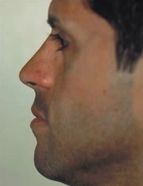 Rhinoplasty. After Treatment Photos - male, left side view, patient 26