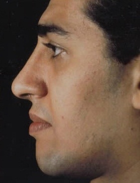 Rhinoplasty. After Treatment Photos - male, left side view, patient 29