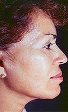 Facelift - After Treatment Photos - female, right side view, patient 3