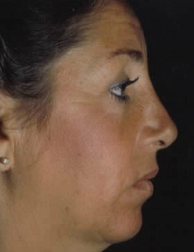 Rhinoplasty. After Treatment Photos - female, right side view, patient 3