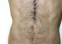 Liposuction Abdomen - After Treatment Photos - male, front view, patient 3