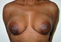 Breast Augmentation: After Treatment Photos - female, front view, patient 3