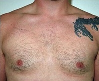 Gynecomastia. After Treatment Photos - male, front view, patient 3