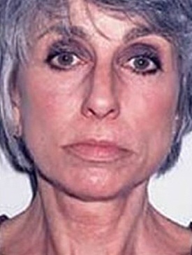 Facelift - After Treatment Photos - female, front view, patient 4