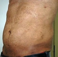 Torsoplasty. After Treatment Photos - male, left side oblique view, patient 4