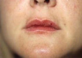 Skin Treatments - After Treatment Photos - female, front view, patient 4 (lips)