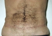 Liposuction Abdomen - After Treatment Photos - male, front view, patient 4
